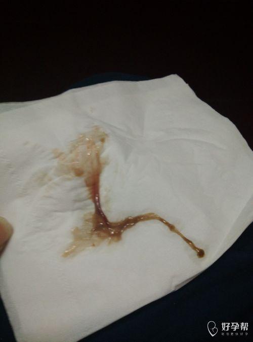 分泌物褐色图片